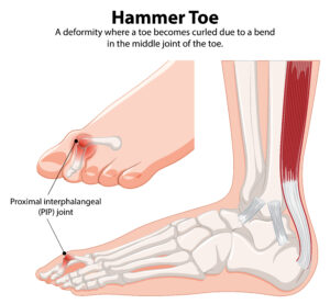 Hammer Toe